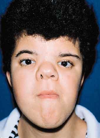 Crouzon syndrome results in lower jaw .